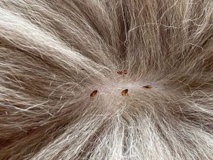 Can You Feel Fleas Crawling In Your Hair Causes & How To Treat