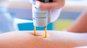 How to Prepare for Laser Hair Removal Do's and Don'ts